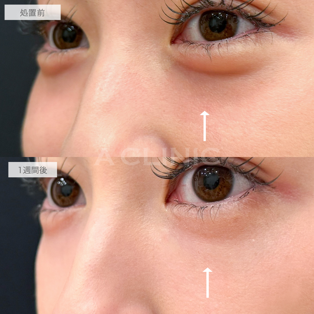 A式コンシーラー注射の症例写真