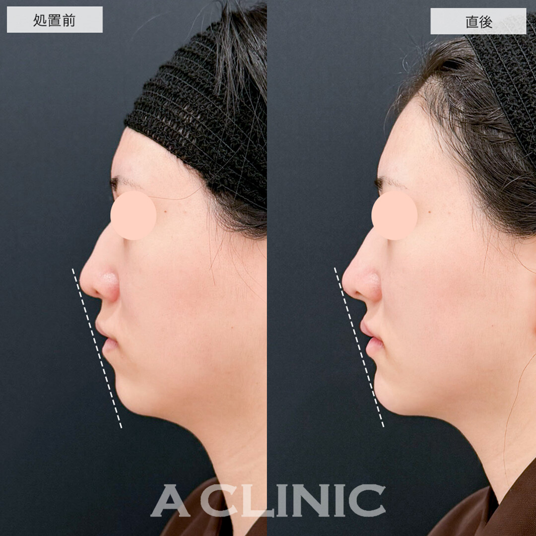 Eライン形成症例写真