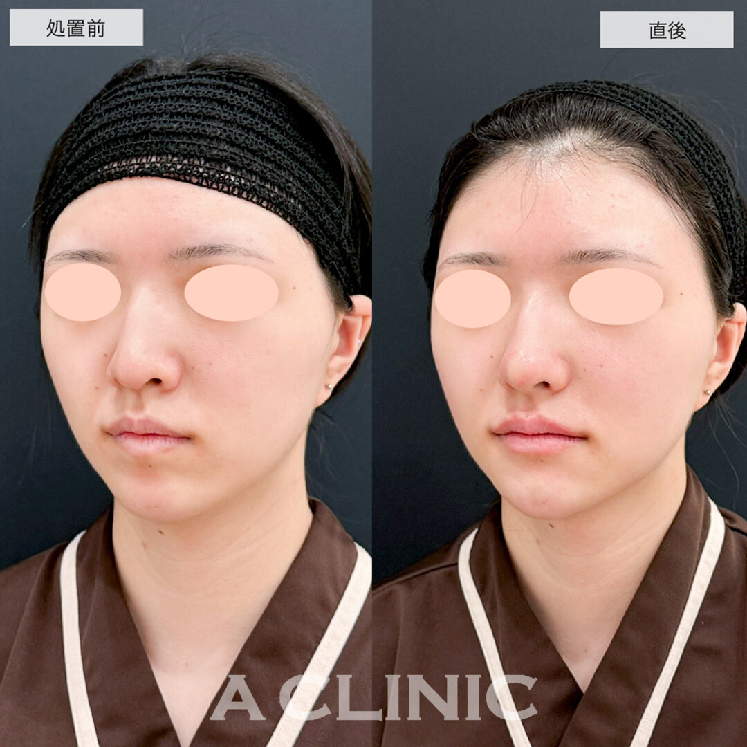 Eライン形成症例写真