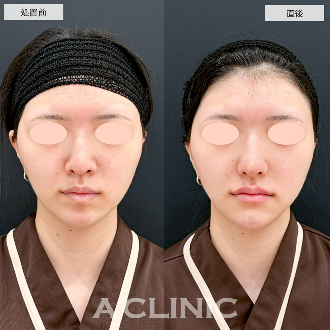 Eライン形成症例写真