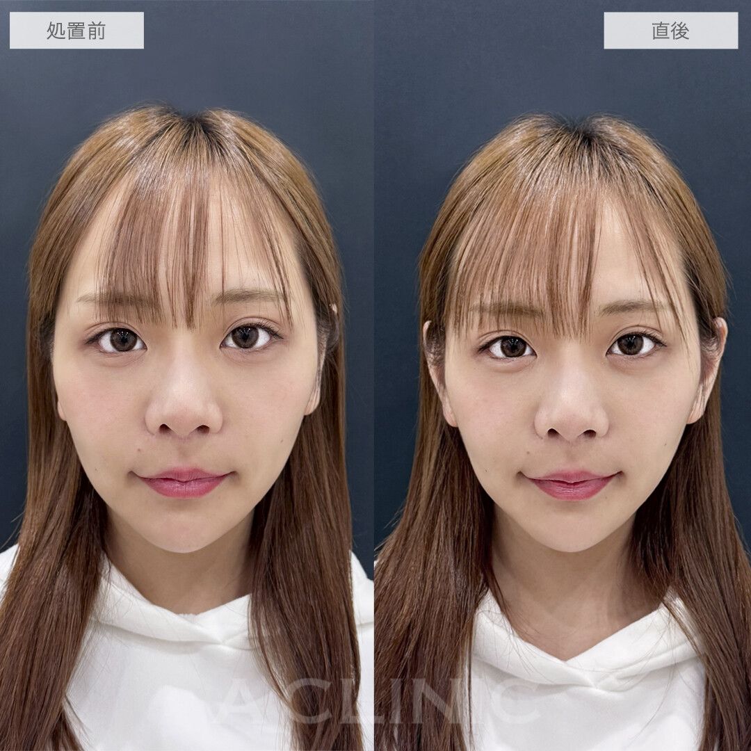 立ち耳ヒアルロン酸注入(ボリューマ)症例写真
