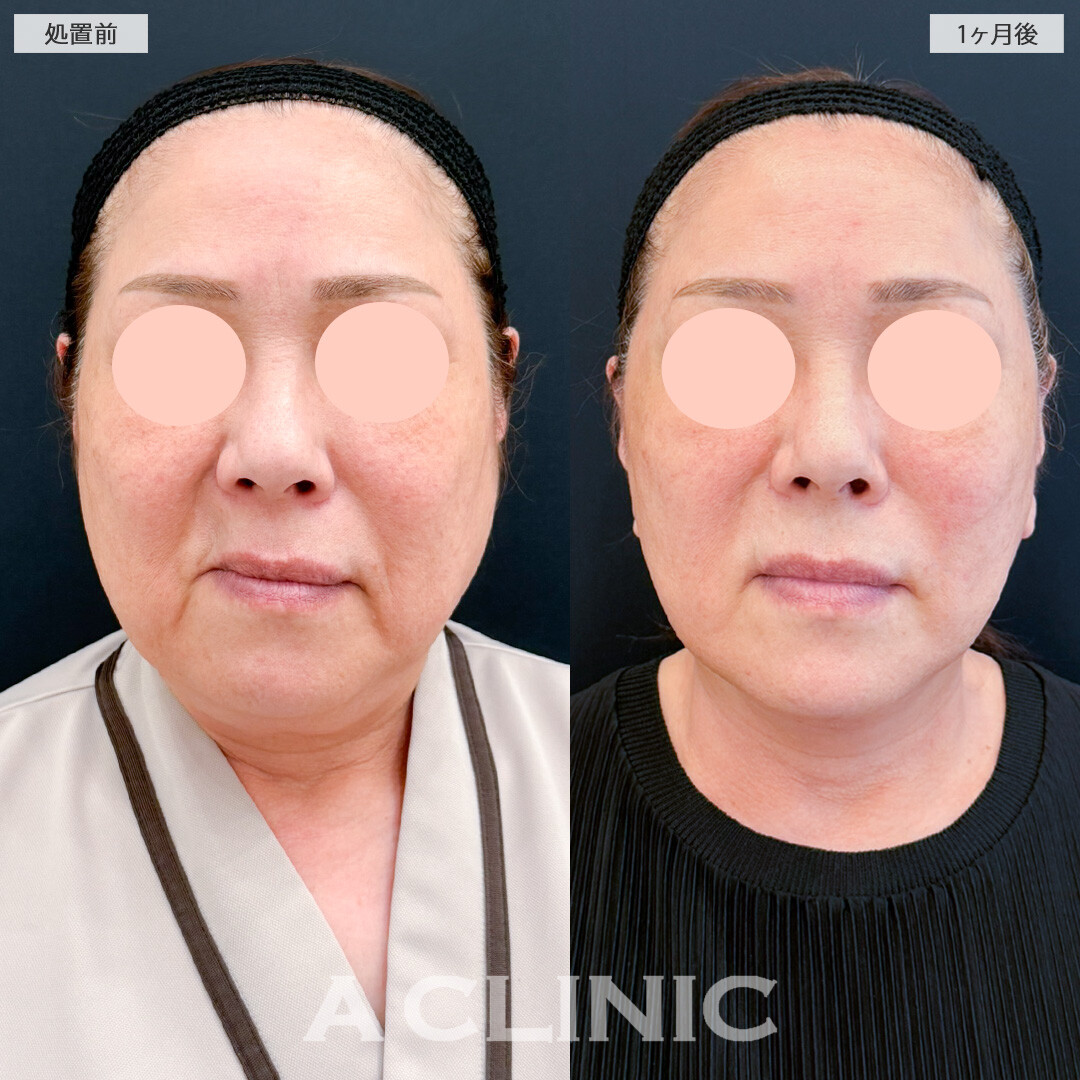 A式ナゾラリフトの症例写真