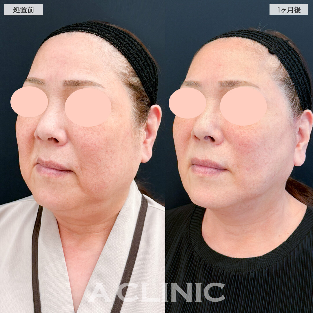 A式ナゾラリフトの症例写真