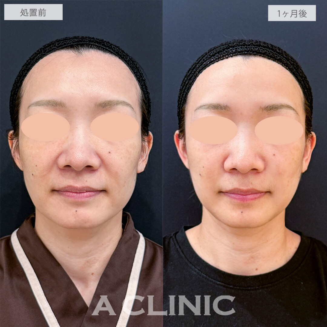 A式ナゾラリフト症例写真