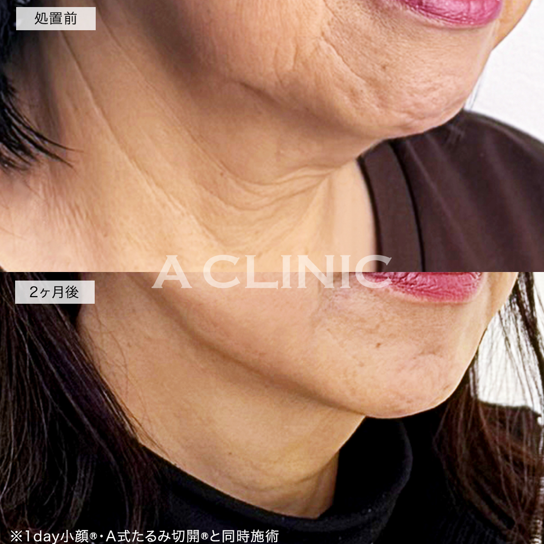 A式ネックリフト症例写真
