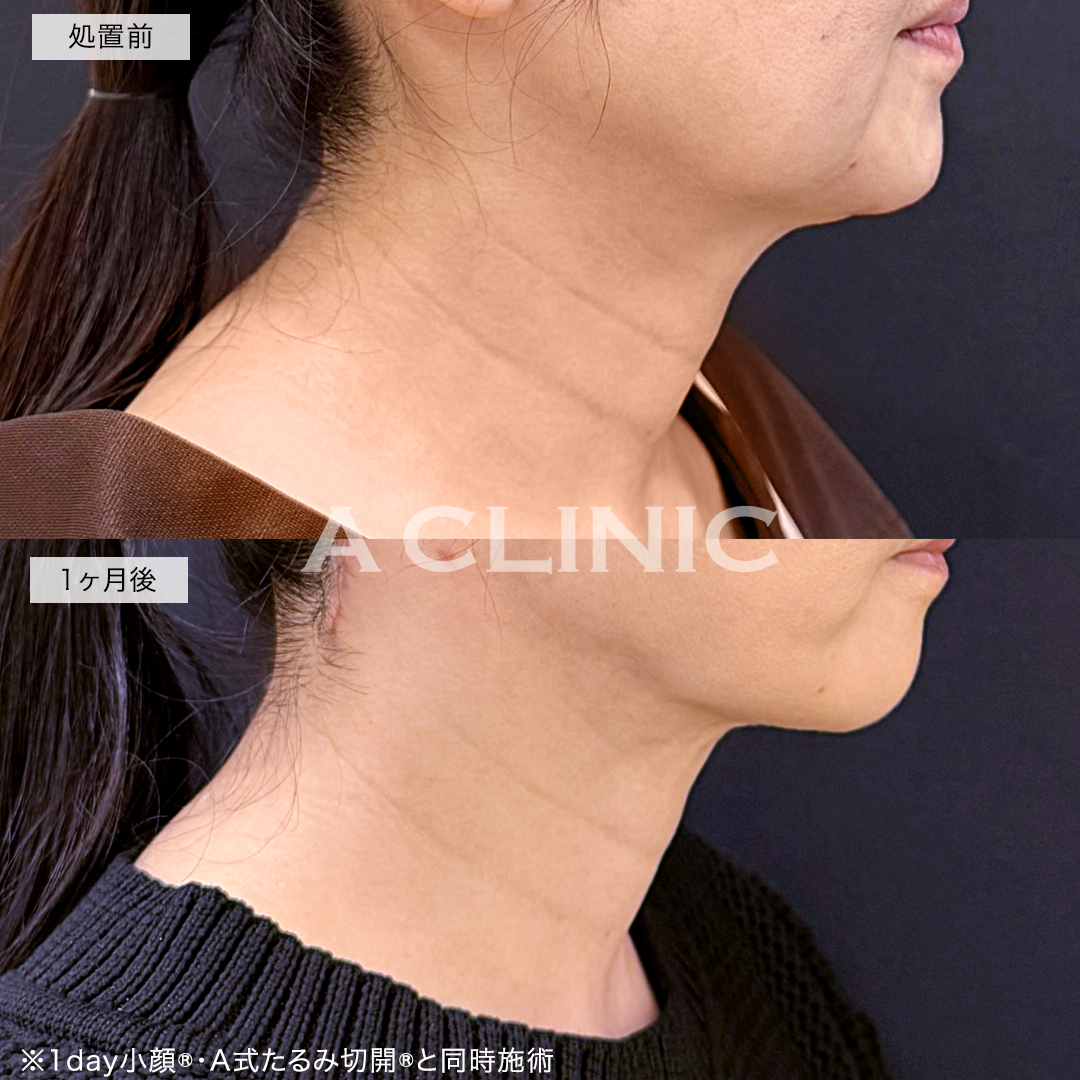 A式ネックリフト症例写真