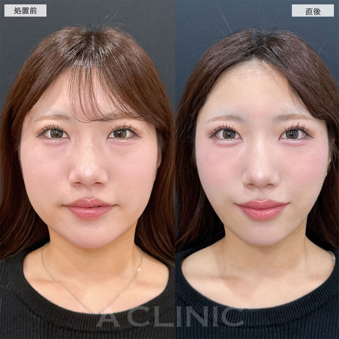 1day小顔脂肪吸引症例写真