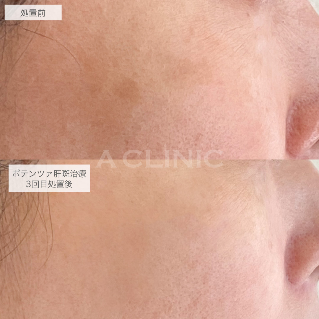 Aポテンツァ肝斑症例写真