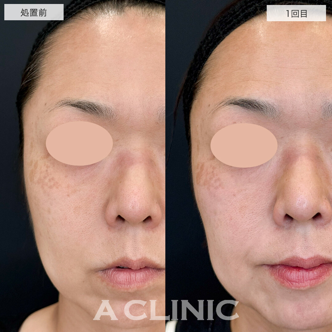 肝斑徹底治療セット