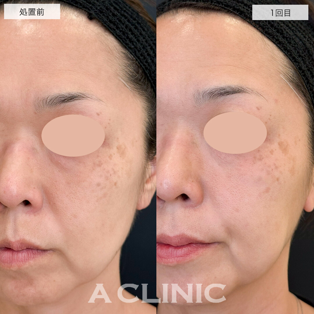 肝斑徹底治療セット