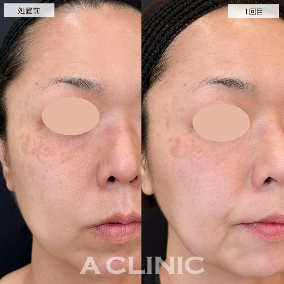 肝斑徹底治療セット