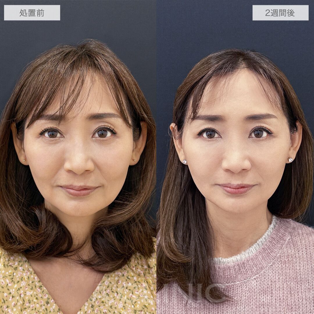 A式美肌たるみ切開症例写真