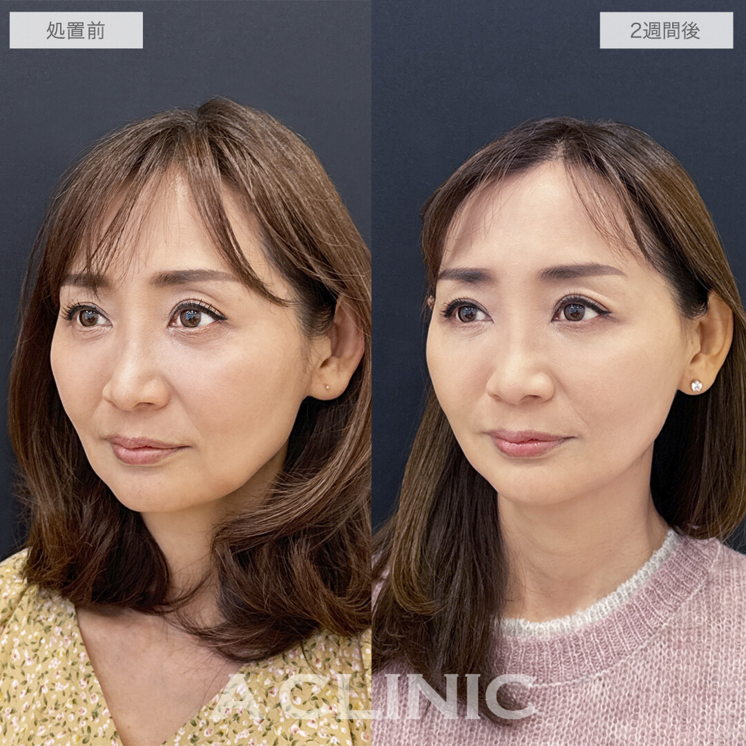 A式美肌たるみ切開