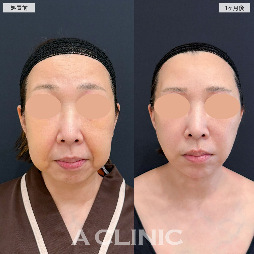 A式美肌たるみ切開