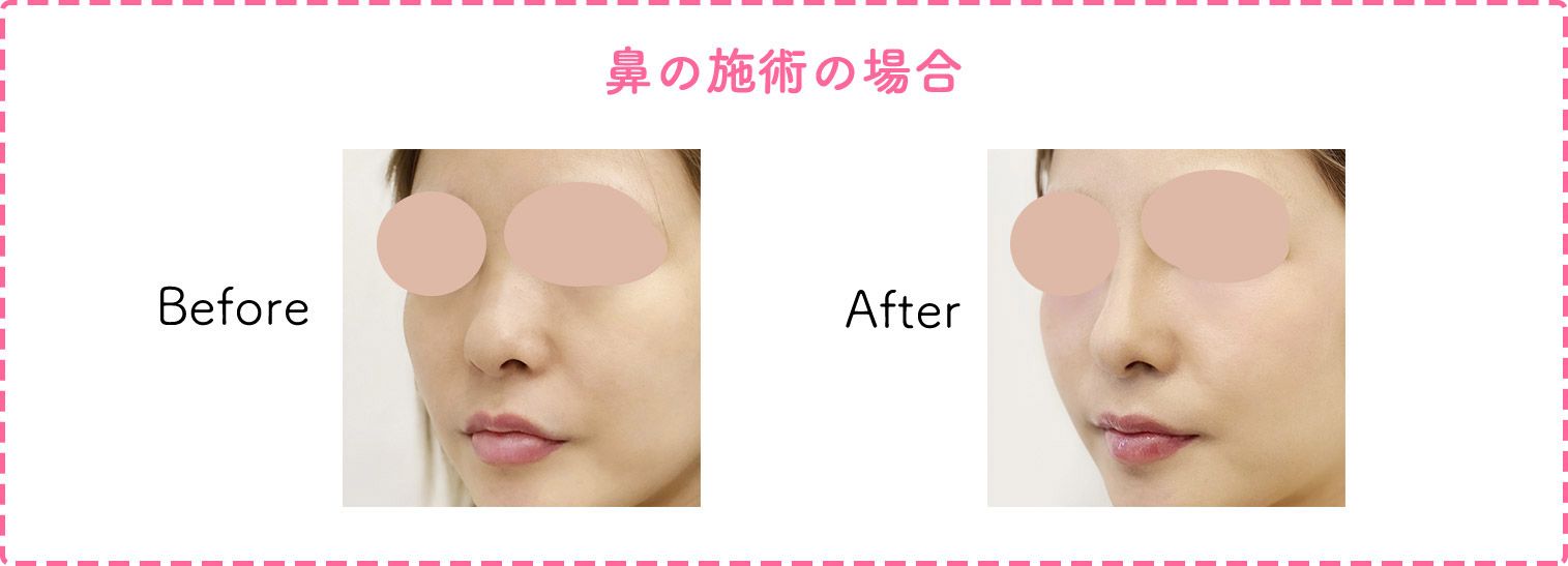 鼻の施術の症例写真