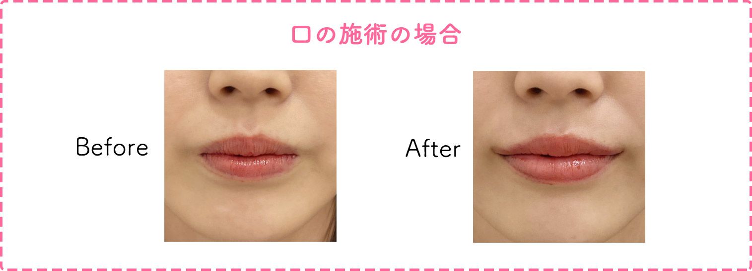 口の施術の症例写真