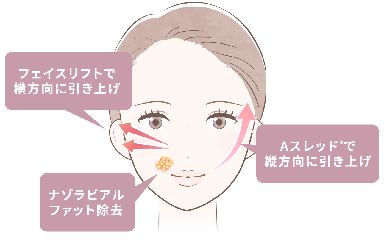 脂肪除去×糸リフト×切開リフト