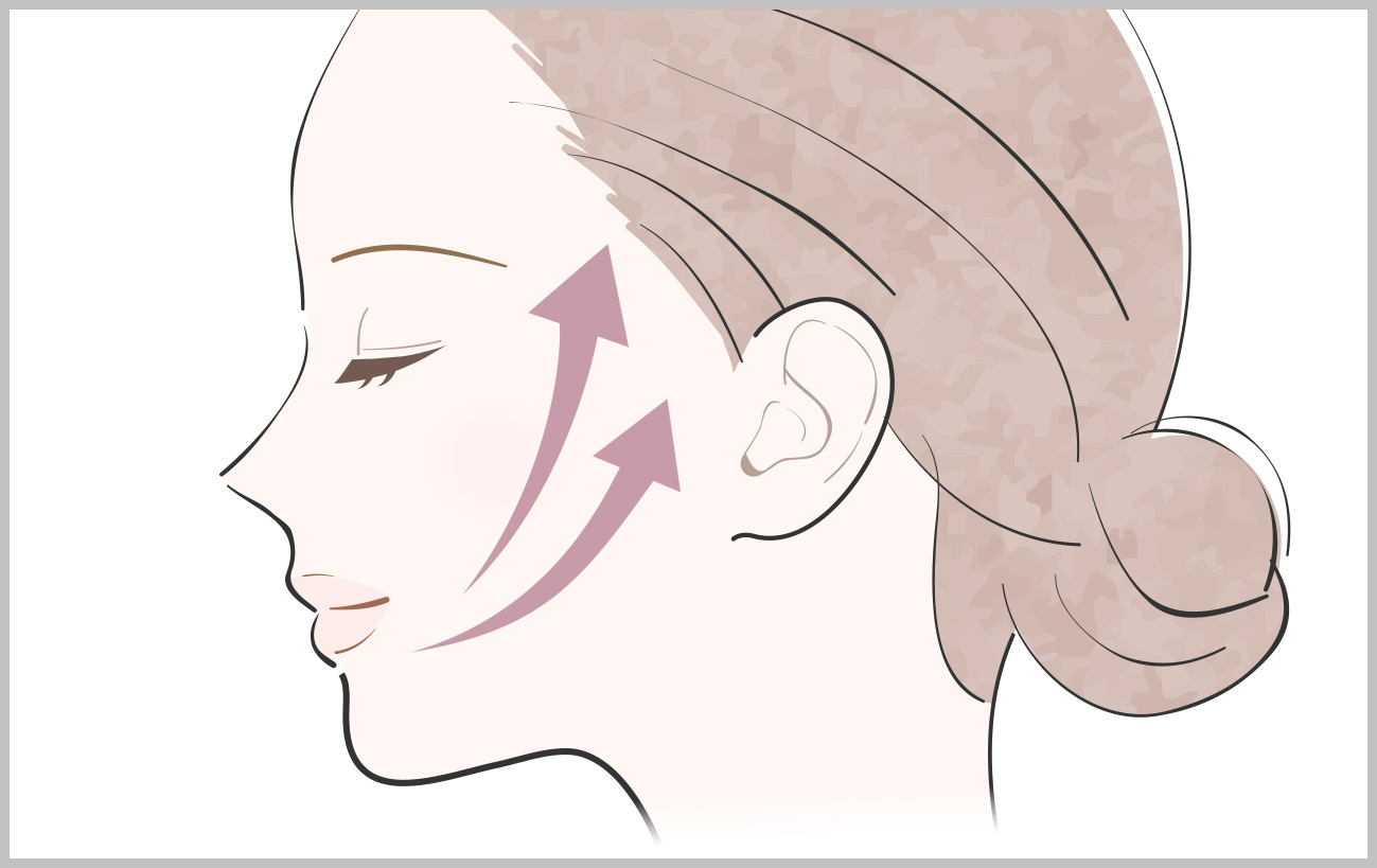 Aスレッド®（糸リフト）