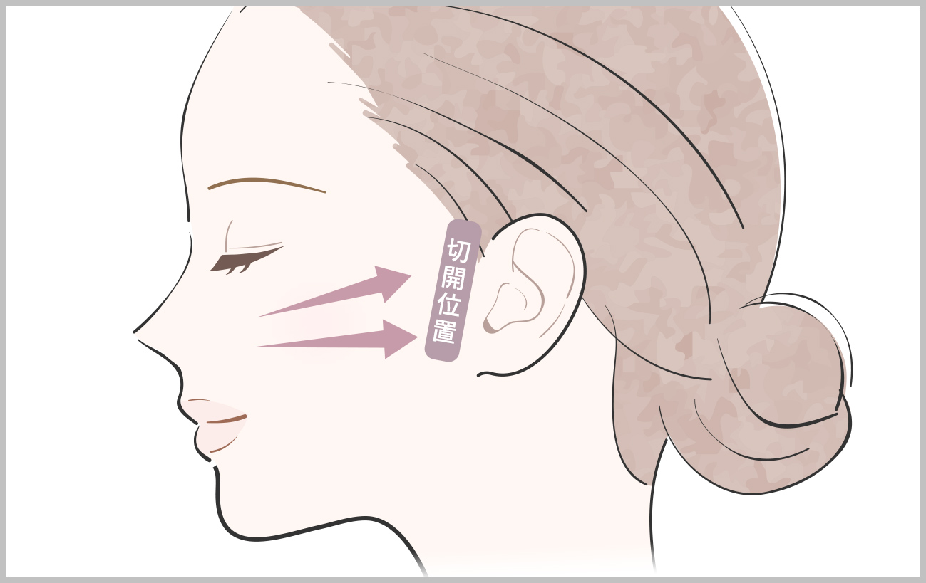 フェイスリフト（切開リフト）