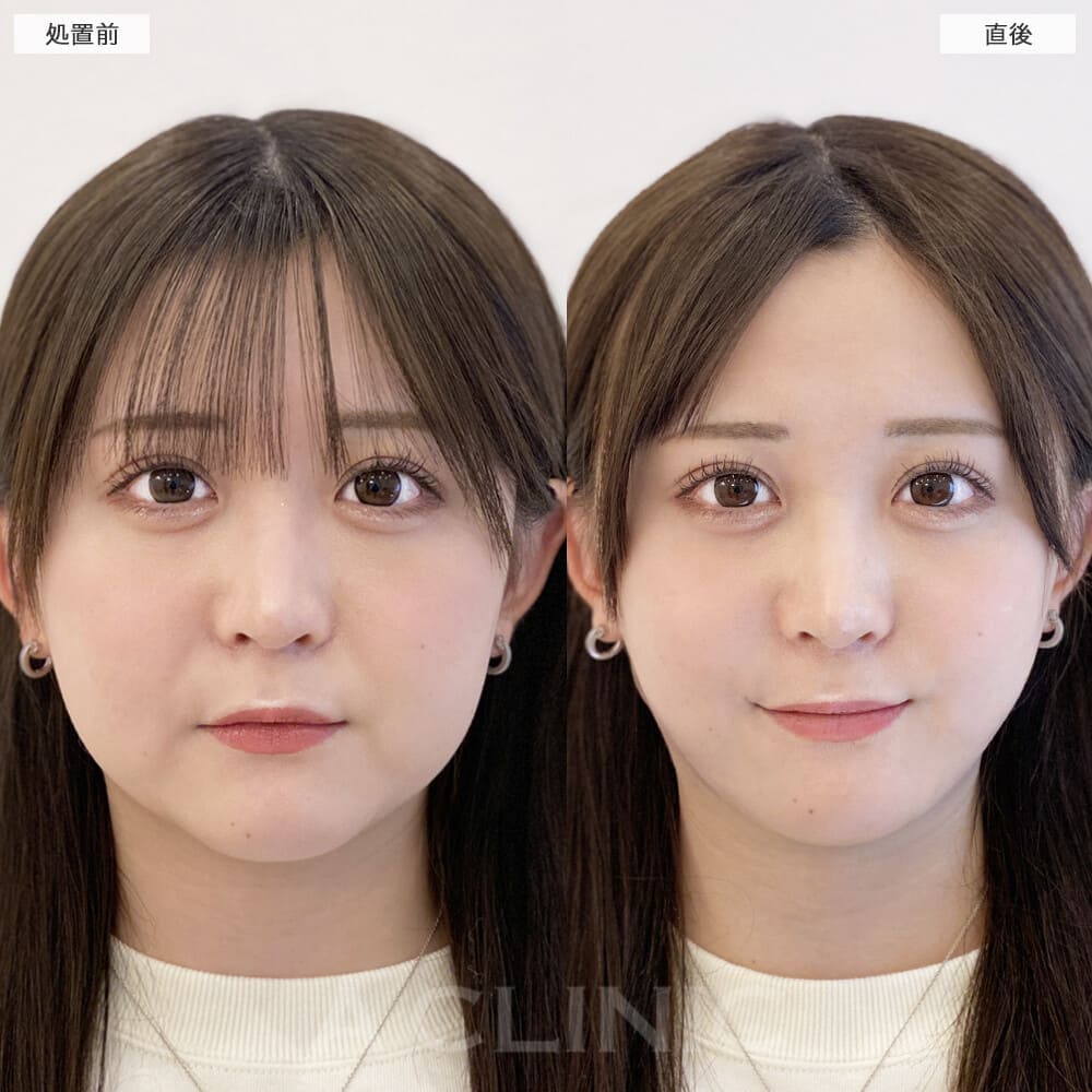 1day小顔脂肪吸引の症例写真BEFORE AFTER 01