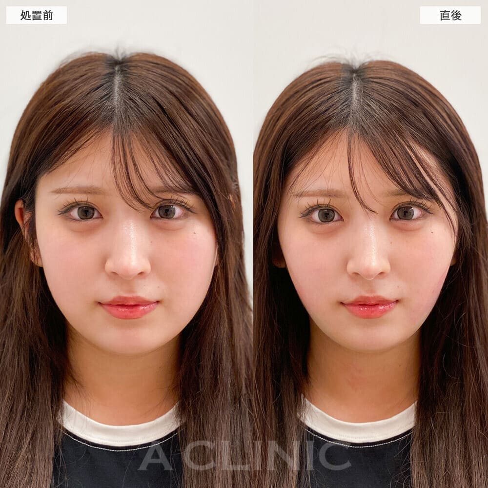 1day小顔脂肪吸引の症例写真BEFORE AFTER 05