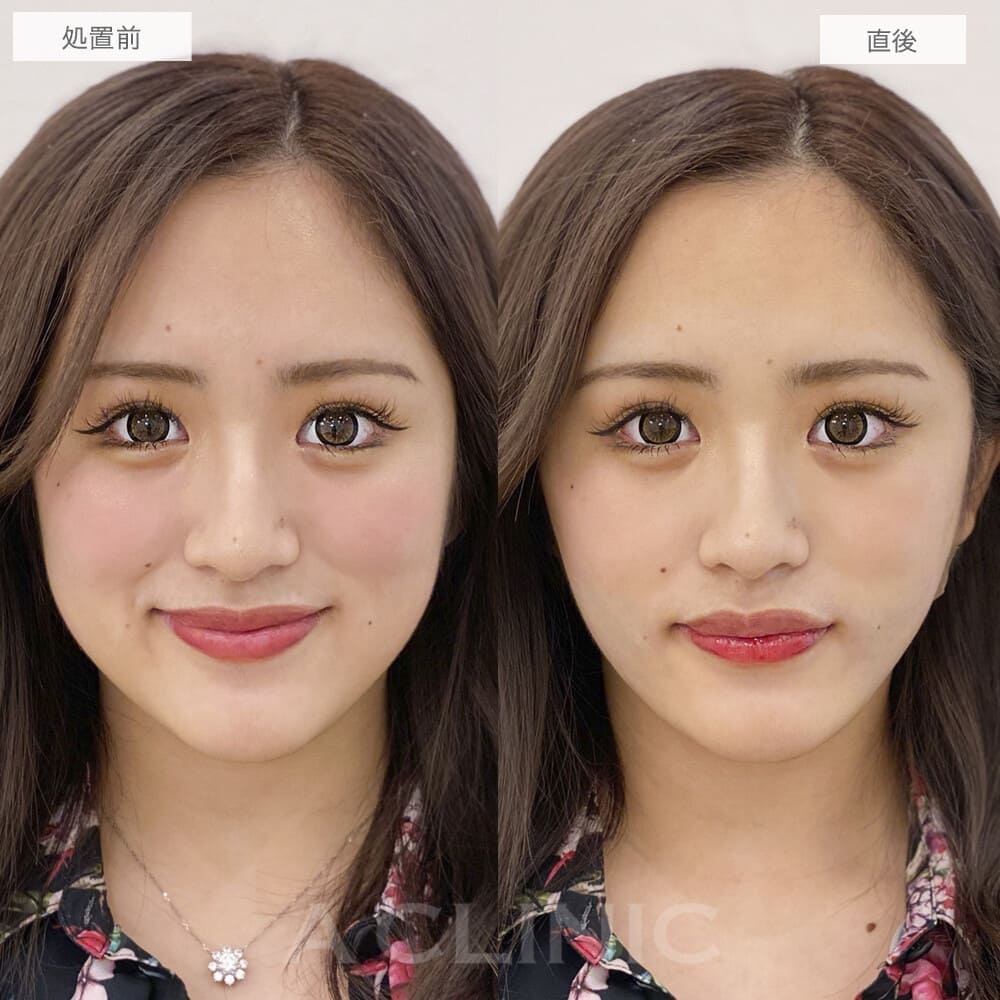 1day小顔脂肪吸引の症例写真BEFORE AFTER 06