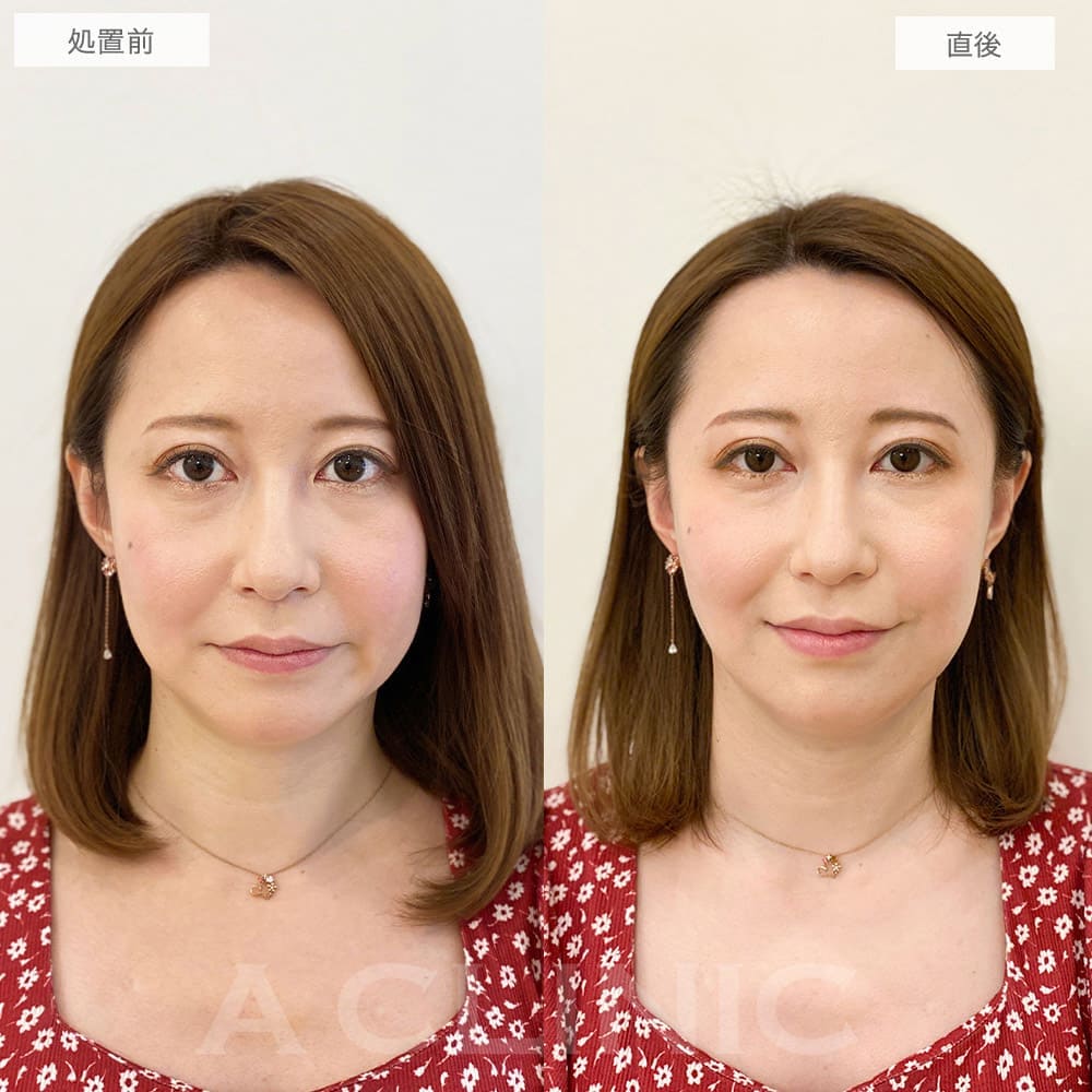 1day小顔脂肪吸引の症例写真BEFORE AFTER 08