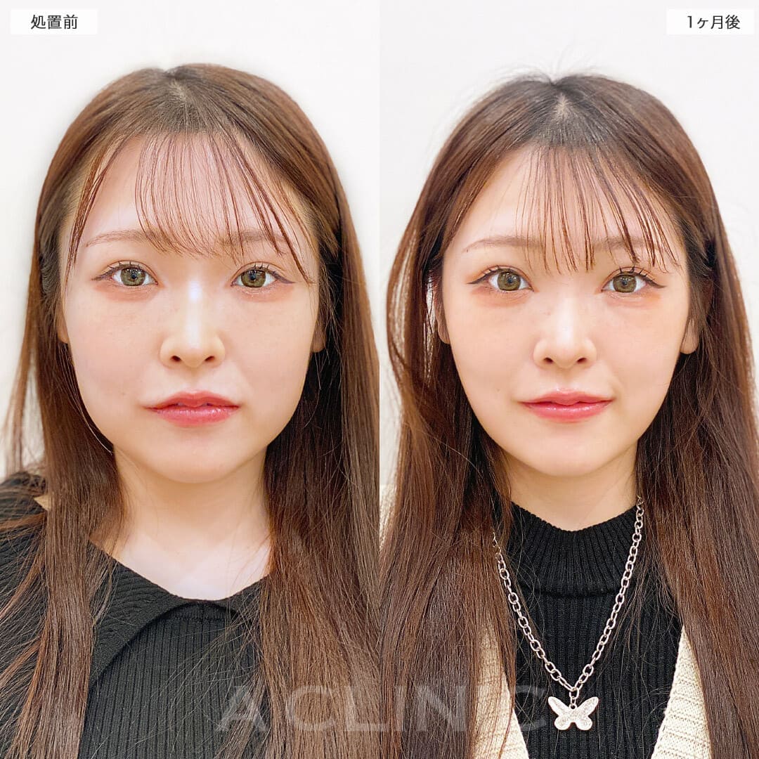 1day小顔脂肪吸引の症例写真BEFORE AFTER 1ヶ月後 01