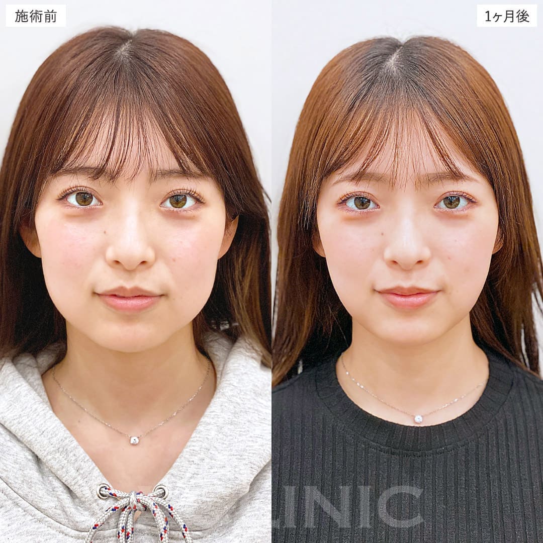 1day小顔脂肪吸引の症例写真BEFORE AFTER 1ヶ月後 02