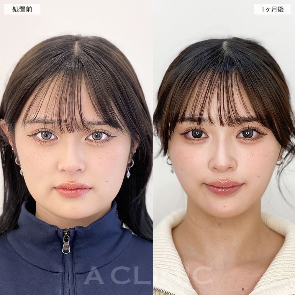 1day小顔脂肪吸引の症例写真BEFORE AFTER 1ヶ月後 03