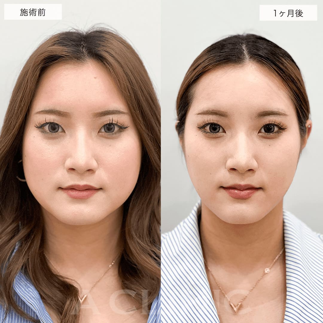 1day小顔脂肪吸引の症例写真BEFORE AFTER 1ヶ月後 04