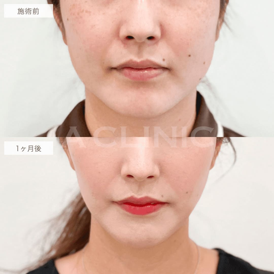 1day小顔脂肪吸引の症例写真BEFORE AFTER 1ヶ月後 06