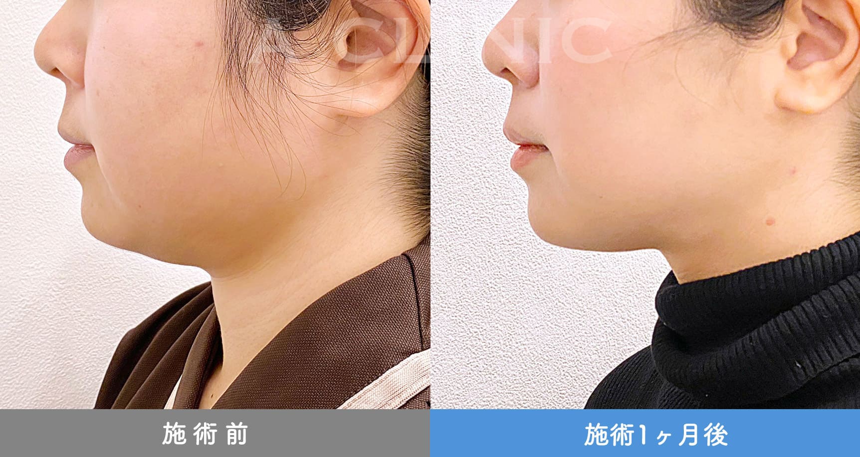 1day小顔脂肪吸引の症例写真BEFORE AFTER 26