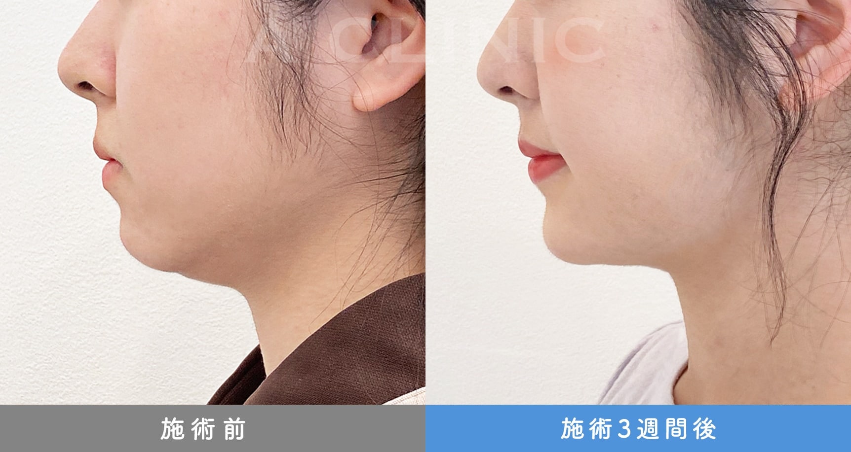 1day小顔脂肪吸引の症例写真BEFORE AFTER 24