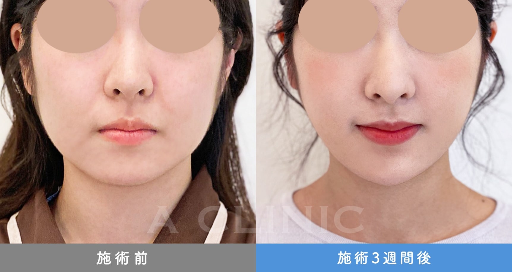 1day小顔脂肪吸引の症例写真BEFORE AFTER 20