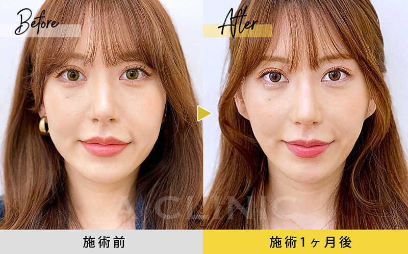 1day小顔脂肪吸引の症例写真BEFORE AFTER 07