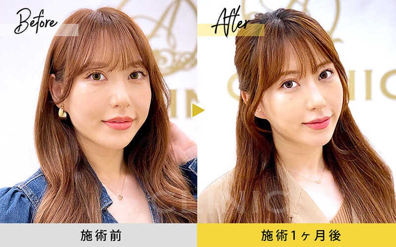 1day小顔脂肪吸引の症例写真BEFORE AFTER 08