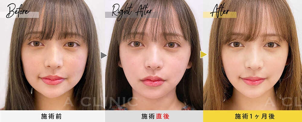 1day小顔脂肪吸引の症例写真BEFORE AFTER 01