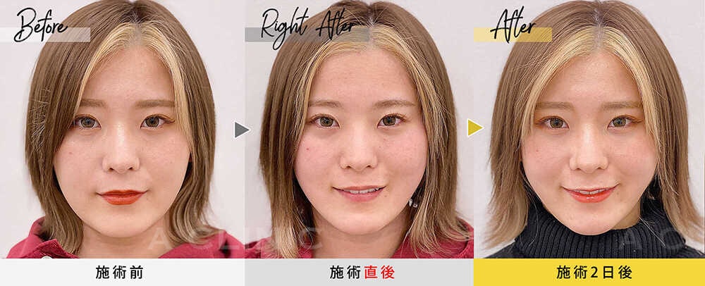 1day小顔脂肪吸引の症例写真BEFORE AFTER 02