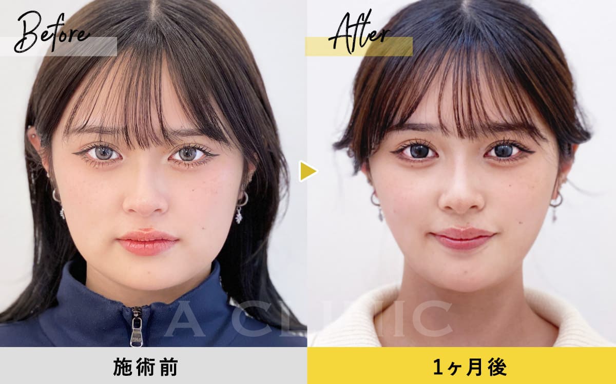 1day小顔脂肪吸引の症例写真BEFORE AFTER 002