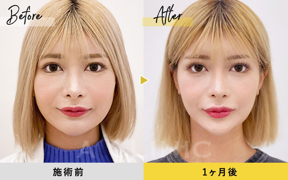 1day小顔脂肪吸引の症例写真BEFORE AFTER 003