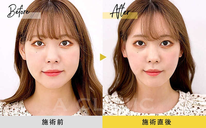 1day小顔脂肪吸引の症例写真BEFORE AFTER 03