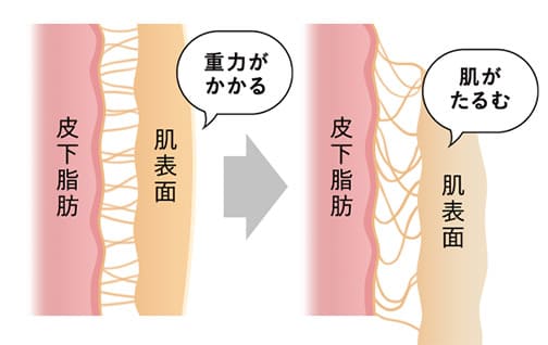 脂肪吸引はたるみの原因？