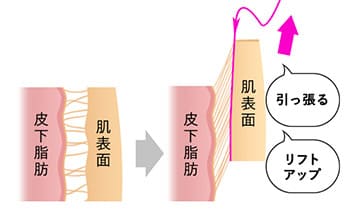 脂肪吸引はたるみの原因？