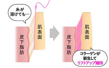 脂肪吸引はたるみの原因？