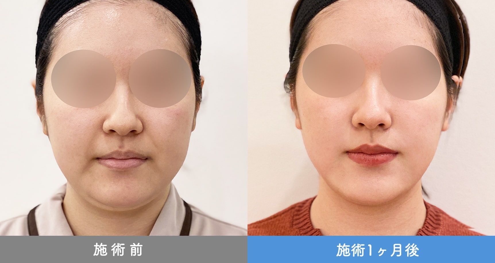 1day小顔脂肪吸引の症例写真BEFORE AFTER 21