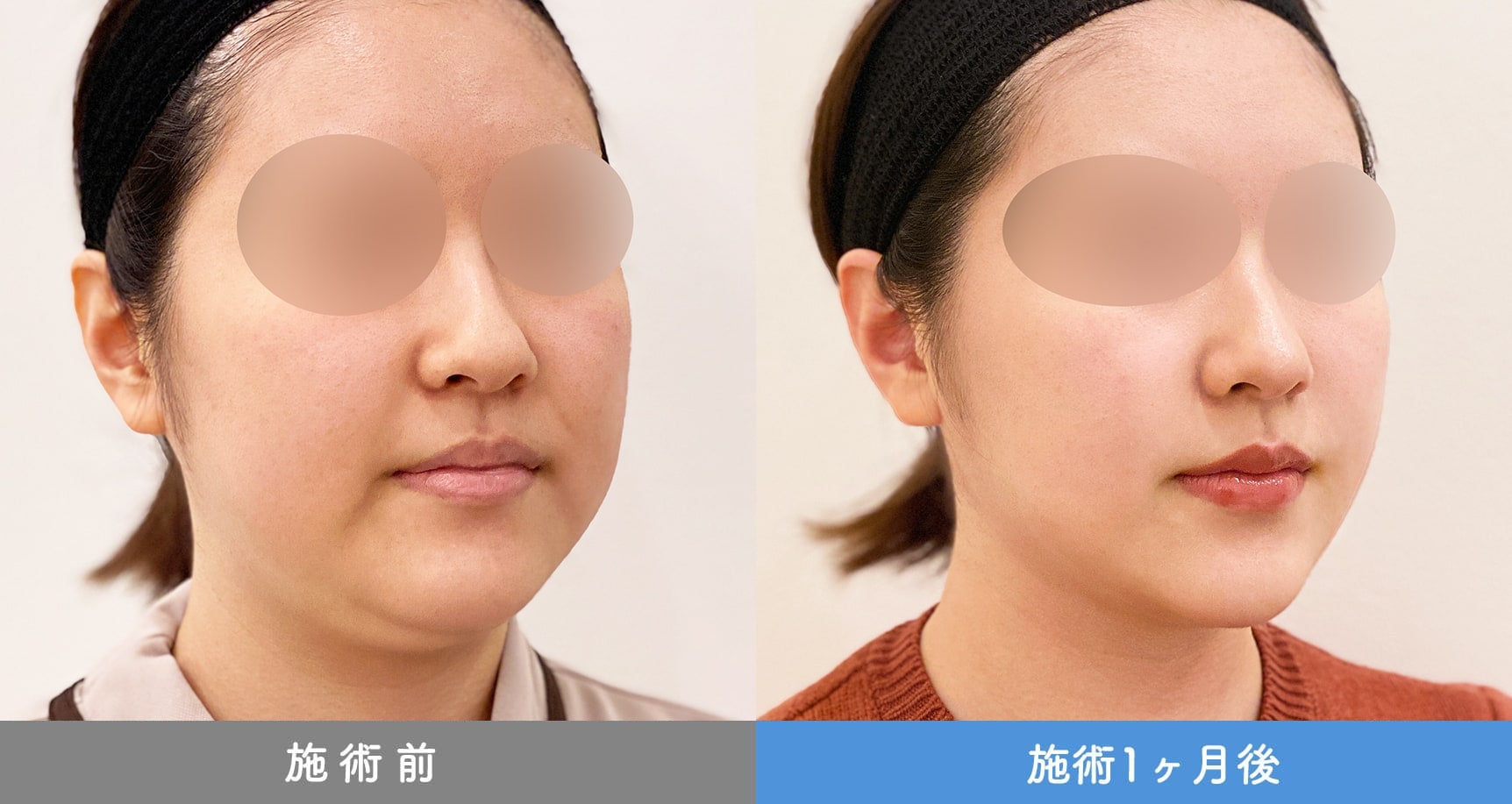 1day小顔脂肪吸引の症例写真BEFORE AFTER 22
