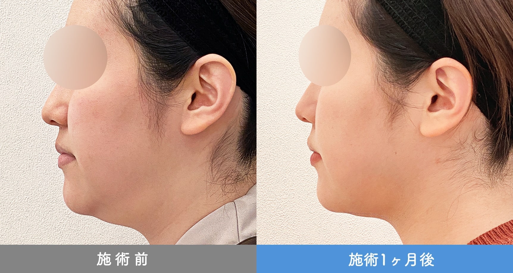 1day小顔脂肪吸引の症例写真BEFORE AFTER 23
