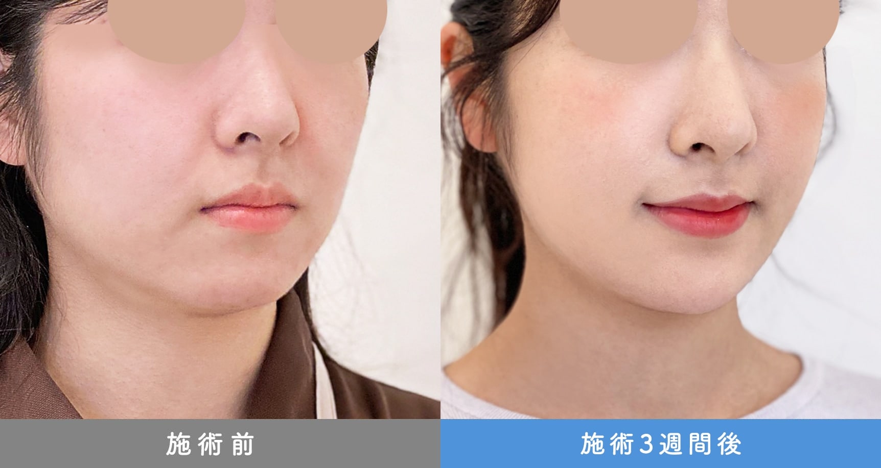 1day小顔脂肪吸引の症例写真BEFORE AFTER 19