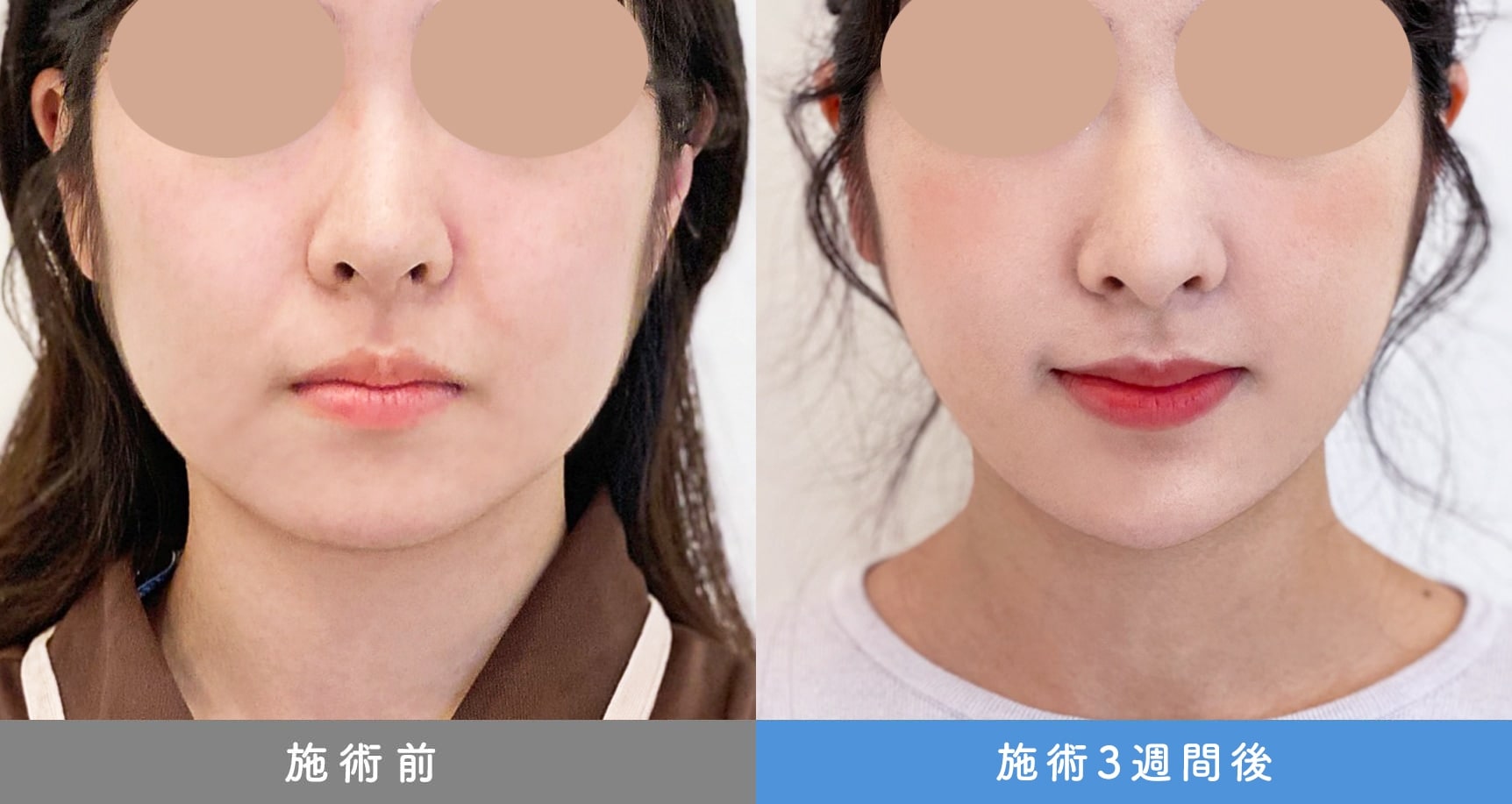 1day小顔脂肪吸引の症例写真BEFORE AFTER 20
